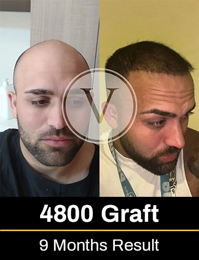 Before After 2