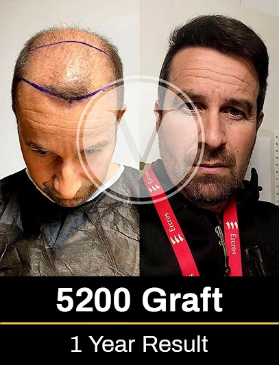 Before After 3