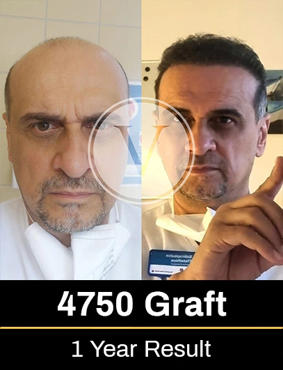 Before After 5
