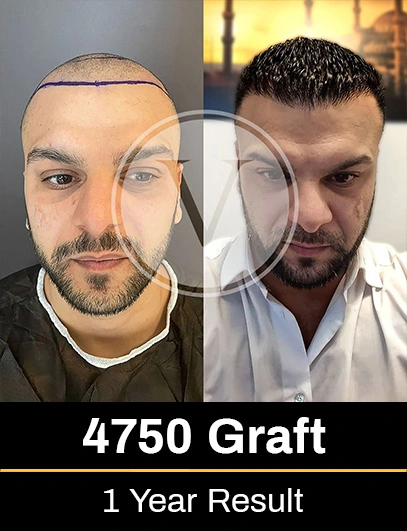 Before After 7
