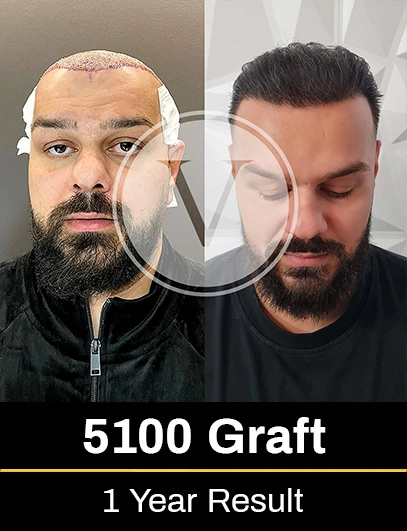 Before After 8